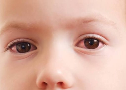 नवजात शिशुको २८ दिनभित्र आँखाको परीक्षण गर्न डाक्टरको सुझाव, कारण यस्तो छ