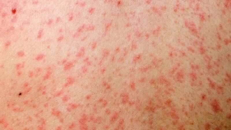 बागलुङको ढोरपाटनमा फैलिएको दादुरा अझै नियन्त्रणमा आएन